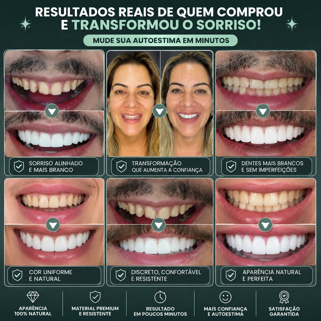 NatureSmile™ SmileUltraFit - Facetas Dentárias Premium de Encaixe Natural