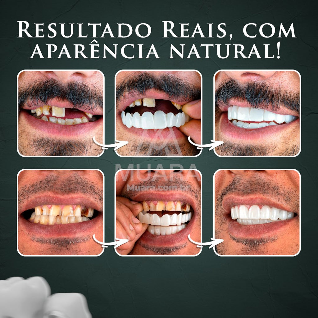 NatureSmile™ SmileUltraFit - Facetas Dentárias Premium de Encaixe Natural