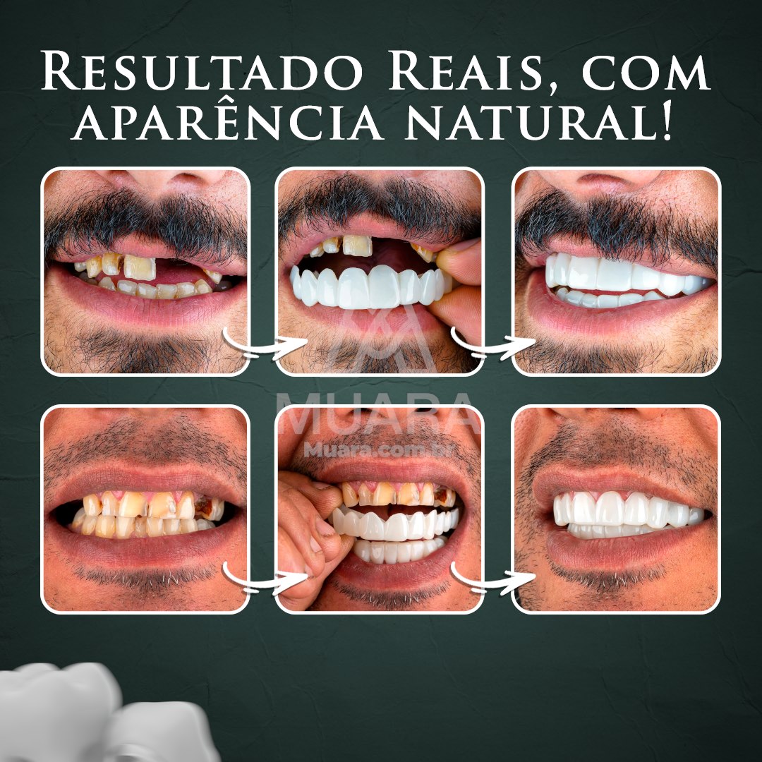 NatureSmile™ SmileUltraFit - Facetas Dentárias Premium de Encaixe Natural